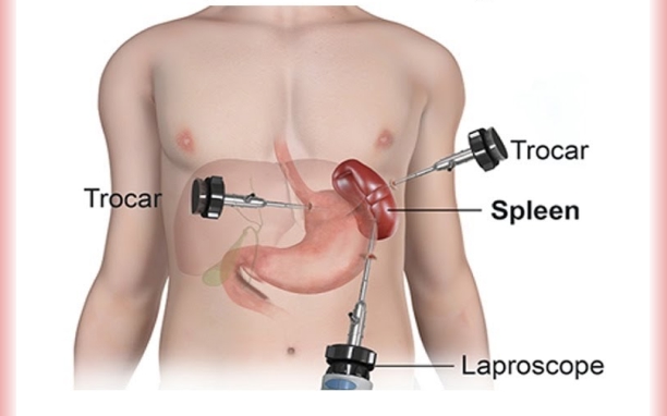 Laparoscopic Myomectomy